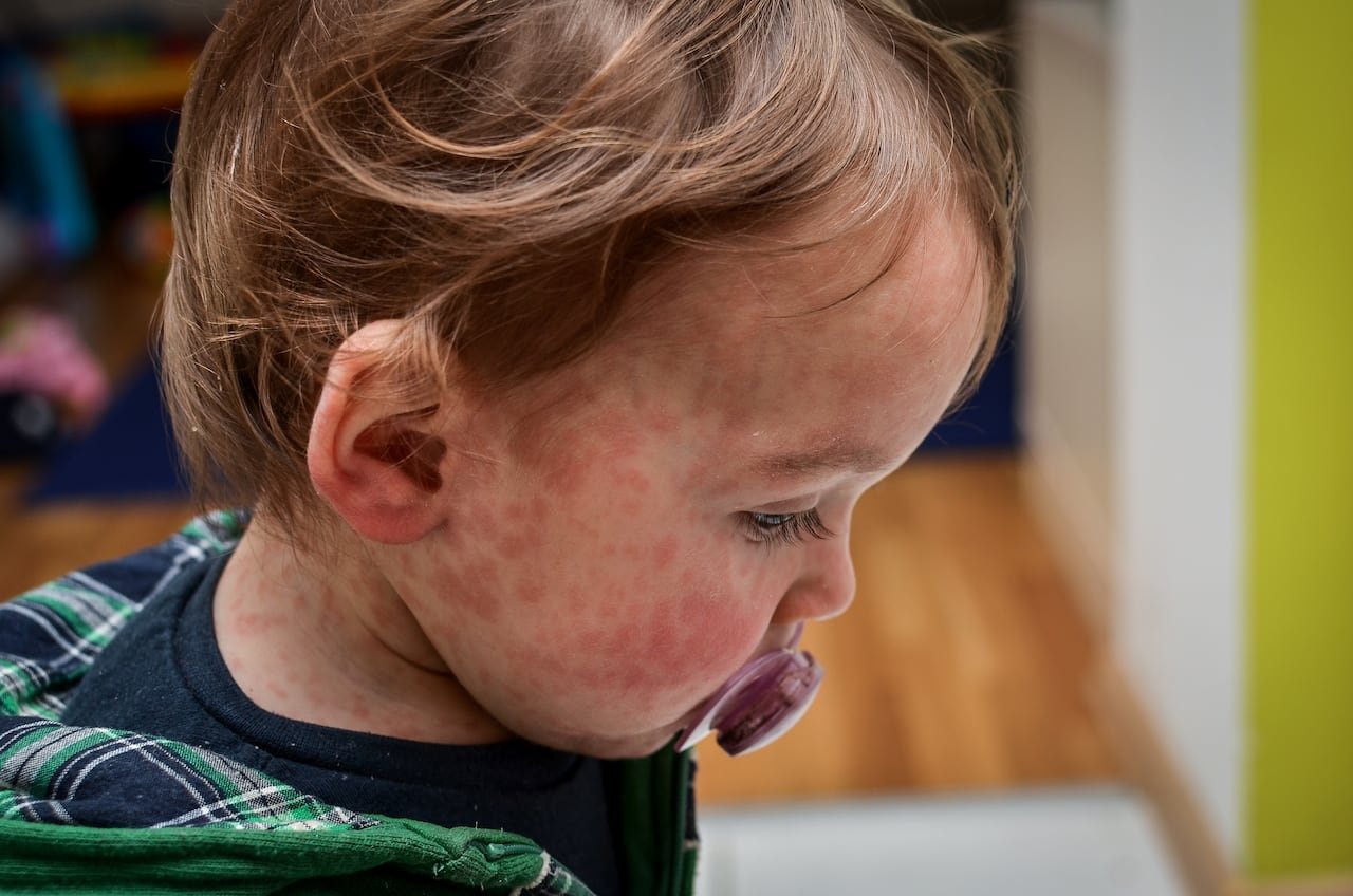 default-567 A toddler with red splotches on his skin has a soother in its mouth.